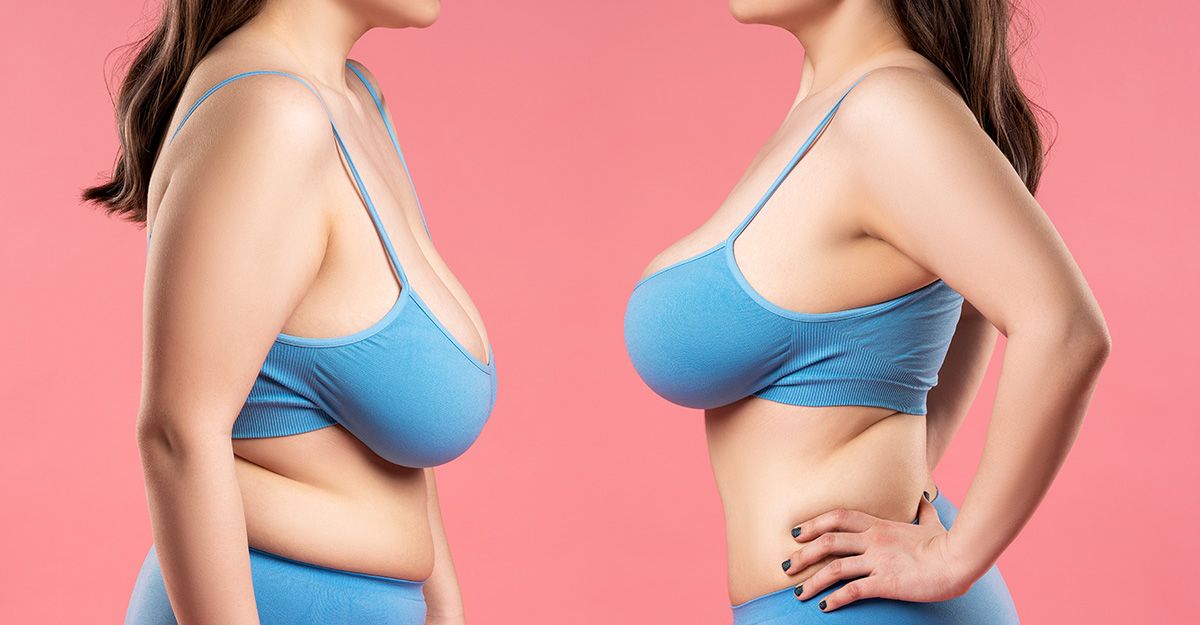 Breast Lift Surgery | Mastopexy